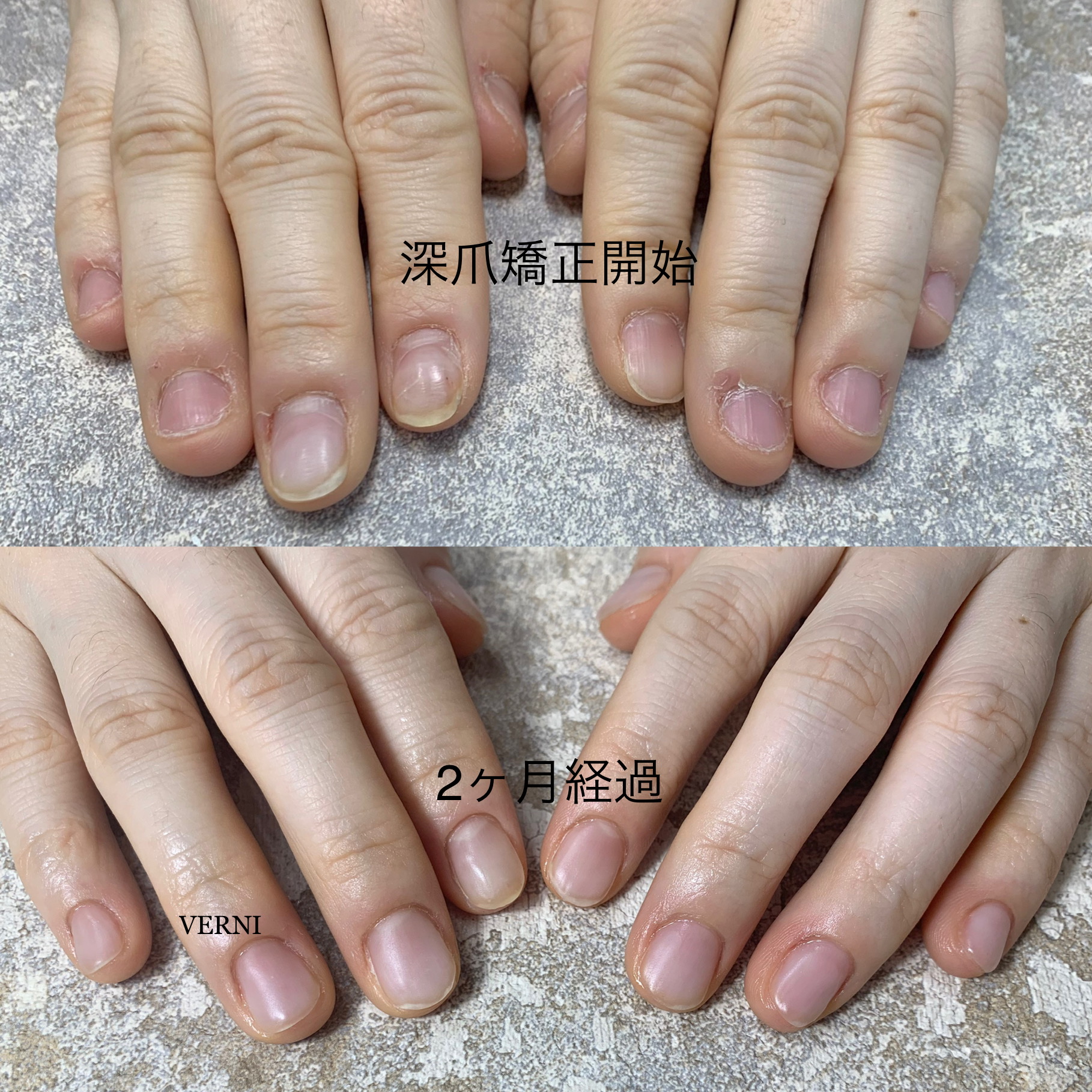 深爪矯正 自爪風クリア仕上げ ２ヶ月経過 Verni